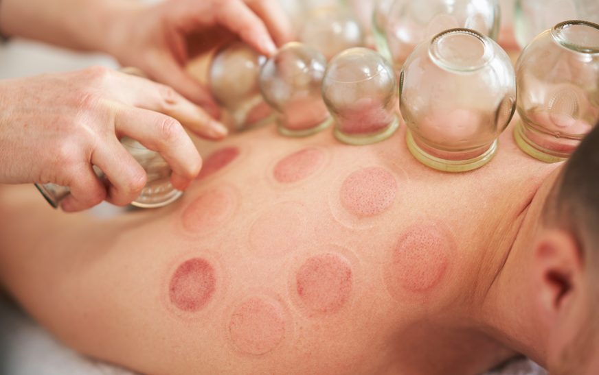 Arthritis Relief Through Hijama and Natural Oils